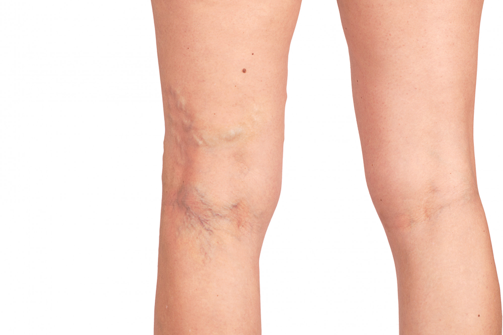 Sclerotherapy  Olds, AB, TH H